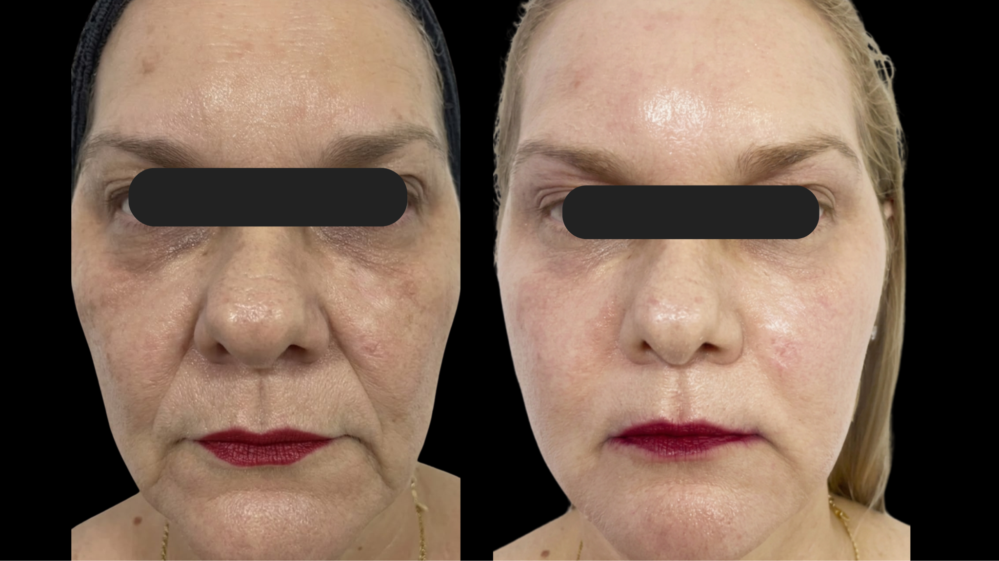 Antes e Depois 2
